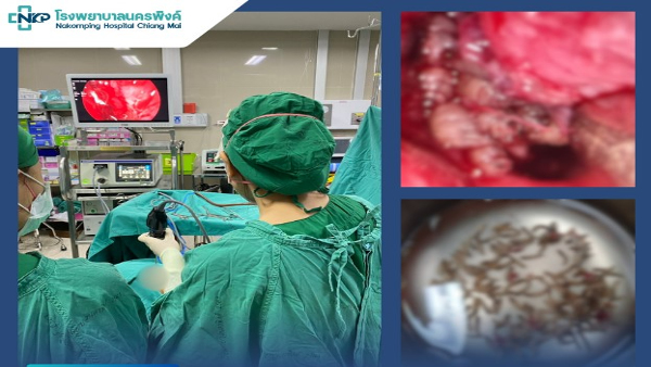 Doctors Rmoved More Than 100 Worms From Woman s Nose