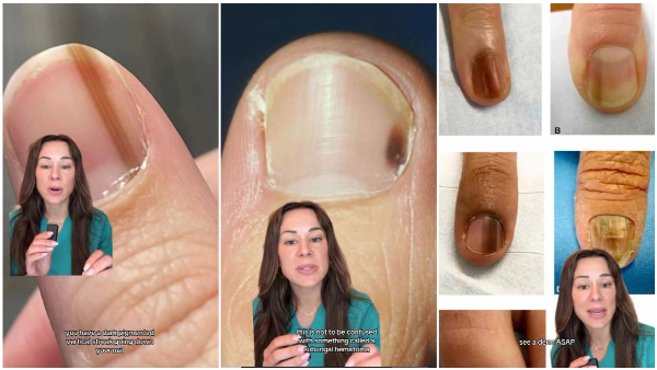 Why Is There A Black Line On Your Nail