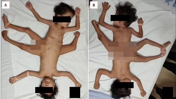 Extremely Rare Conjoined Twins Born Medical Miracle Extremely Rare Conjoined Twins Born Medical Miracle
