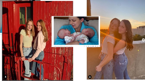 Conjoined Twins Abby and Isabelle