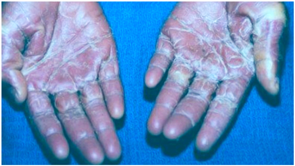 Flesh Eating Bacteria Outbreak What Are The Symptoms Flesh Eating Bacteria Outbreak What Are The Symptoms