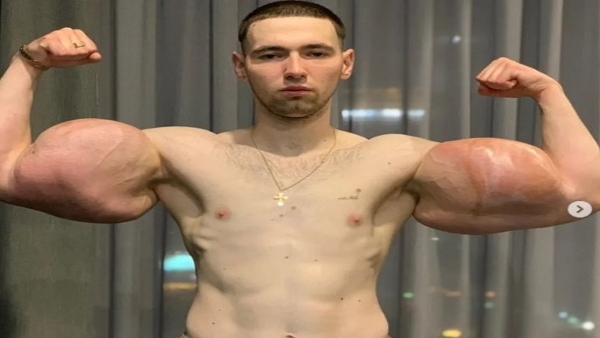 A Young Man Injected 6 Liters Of Vaseline In His Hands