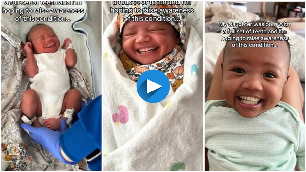 Baby Born with Rare Condition 32 Teeth a Surprise for New Parents
