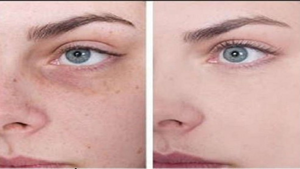 Home Remedies For Removal Of Blackheads From Face