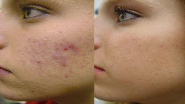 Home Remedies For Remove Black Marks From Skin In Kannada