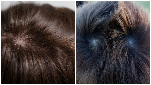 What Does It Mean If There Are More Than Two Whorls In The Head