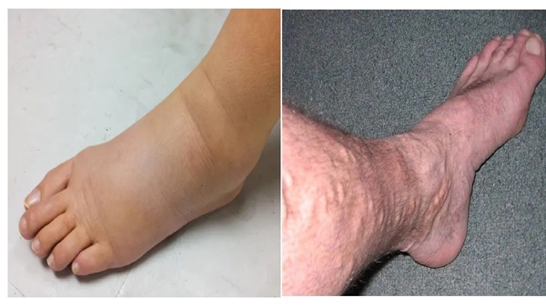 High Cholesterol Symptoms In Legs