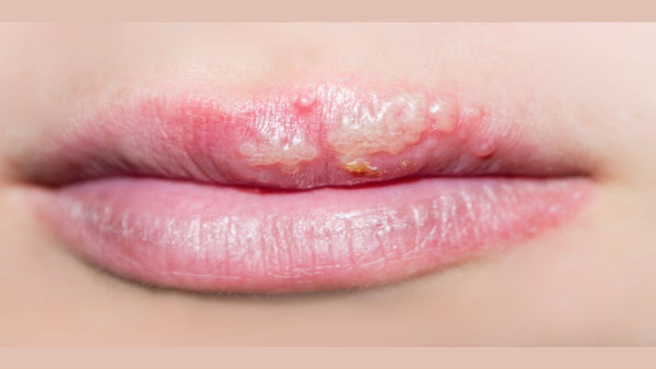 Did You Know About Lip Cancer What Does Lip Cancer Look Like