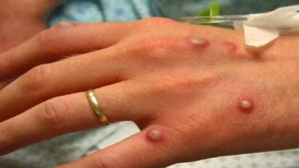 Health Emergency Declared For Monkey Fox Danger Awaits India too