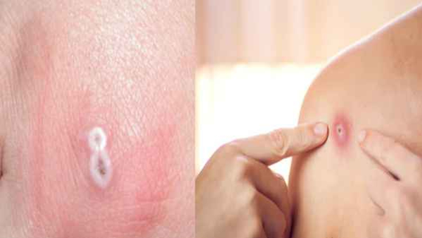 Health Emergency Declared For Monkey Fox Danger Awaits India too