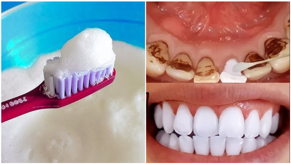 How To Remove Old Stains From Teeth Here Are Home Remedies For Whitening Teeth