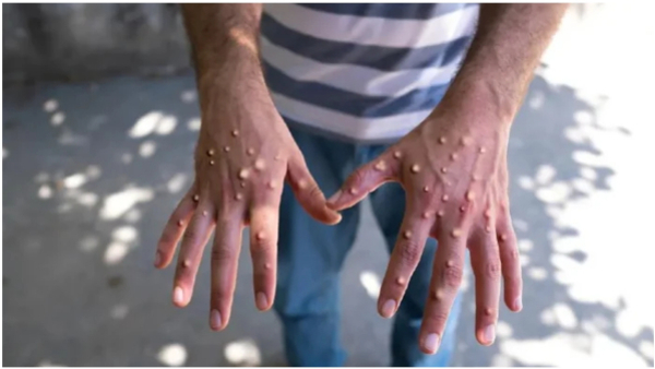 Alert In Mpox Bengaluru 21 days Quarantine And Screening In Airport