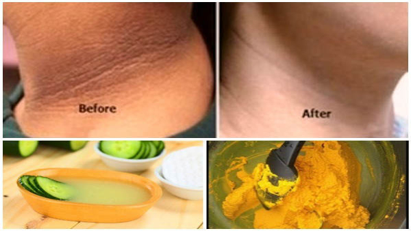 Dark Spot On Around The Neck Home Remedy For Dark Neck
