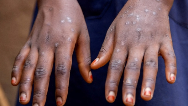 Another Suspected Mpox Was Found In Kerala