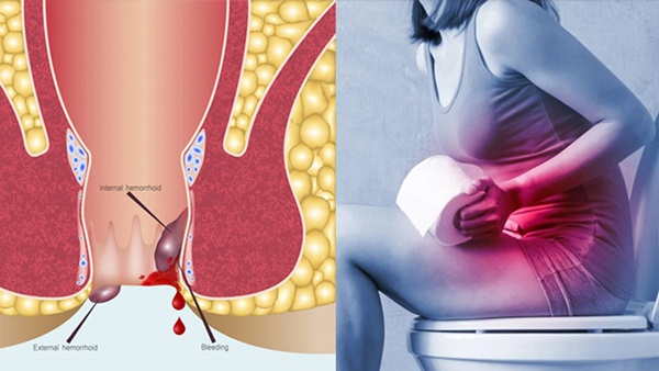 Hemorrhoids Hemorrhoids