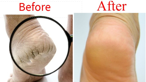Solution For Cracked Heels Easy Way At Home In Kannada