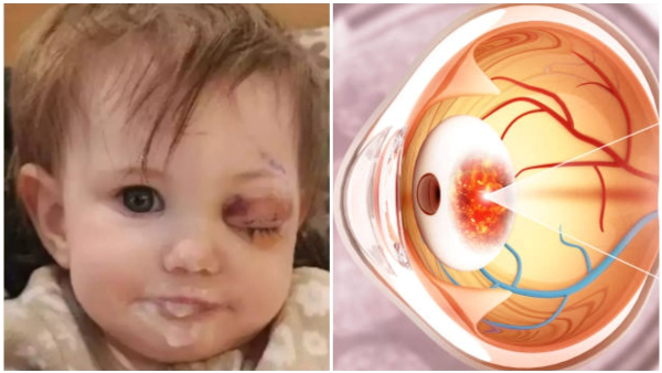 1-Year-Old Loses Eye To Retinal Cancer What You Need To Know