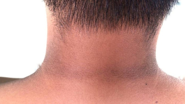 How To Get Rid Of Black Dark Patch At Neck In Kannada