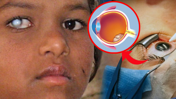 Potential Retina Issue Warning Signs Expert Suggestion Potential Retina Issue Warning Signs Expert Suggestion