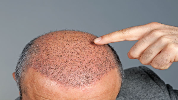 Hair Transplant Gone Wrong Engineer Death Sparks Safety Debate