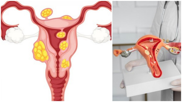 Endometrial Cancer Often Goes Unnoticed Do You Know How To Protect Yourself Endometrial Cancer Often Goes Unnoticed Do You Know How To Protect Yourself