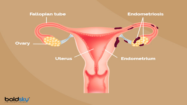 Endometrial Cancer Often Goes Unnoticed Do You Know How To Protect Yourself Endometrial Cancer Often Goes Unnoticed Do You Know How To Protect Yourself