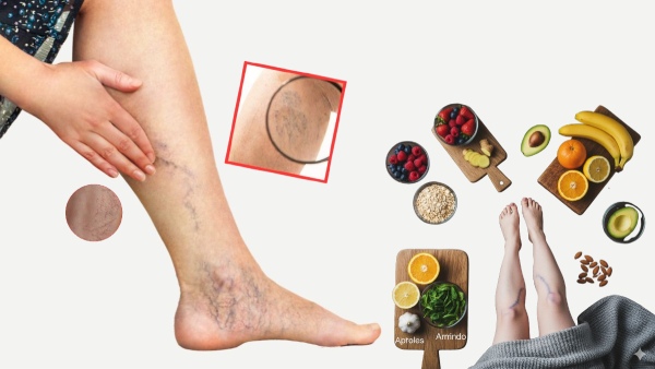 Varicose Veins Treatment at Home