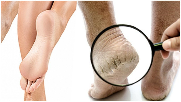 Easy And Effective Way To Prevent Cracked Heels In Winter At Home