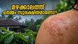 മഴക്കാലത്ത് ചർമ്മവും തലയോട്ടിയും സുരക്ഷിതമാണോ? അണുബാധകളെ തടയാൻ ഈ മുൻകരുതലുകൾ എടുക്കൂ