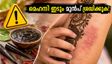 ആഘോഷങ്ങൾക്കിടയിൽ മെഹന്ദി ഇടുന്നവരാണോ? കടും കറുപ്പ് നിറം നൽകുന്ന 'ബ്ലാക്ക് ഹെന്ന'യിലെ ഈ അപകടം അറിയാതെ പോകരുത്