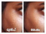 കവിളിലെ കറുത്ത പുള്ളികള്‍ 15ദിവസം കൊണ്ട് മായ്ക്കാം