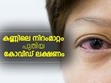 കണ്ണിലെ പിങ്ക് നിറം പുതിയ കോവിഡ് ലക്ഷണം; ഗവേഷണം