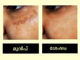  മുഖത്തെ കരുവാളിപ്പകറ്റി ചര്‍മ്മം ക്ലിയറാക്കും മുത്തശ്ശി സൂത്രം