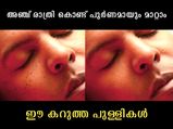 ചര്‍മ്മത്തിലെ കറുത്ത കുത്തുകള്‍ അഞ്ച് രാത്രിയില്‍ ഇല്ലാതാക്കാം