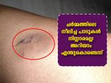  ചര്‍മ്മത്തില്‍ ചതവുകള്‍ സ്ഥിരമോ: അറിയാം കാരണവും പരിഹാരവും