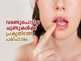 ശൈത്യകാലത്ത് വരണ്ടുപൊട്ടുന്ന ചുണ്ടിന് പ്രകൃതിദത്ത പരിഹാരം വീട്ടില്‍ത്തന്നെ