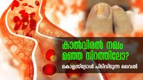  കൈകാലുകള്‍ ഒന്ന് ശ്രദ്ധിക്കൂ: കൊളസ്‌ട്രോള്‍ ഗുരുതരാവസ്ഥയിലാണോ അറിയാം