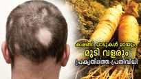 മുടി കൊഴിയുന്നത് കൂട്ടമായി; അലോപ്പീസിയ ഏരിയറ്റ എന്ന വില്ലനെ തടയാന്‍ 5 പ്രതിവിധികള്‍