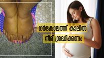  ഗര്‍ഭകാലത്ത് കാലില്‍ നീരും വേദനയും: അതും രാത്രിയെങ്കില്‍ ചില സൂചനകള്‍