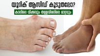 യൂറിക് ആസിഡ് അളവിലെ മാറ്റം: കാലിലെ തള്ളവിരല്‍ പറയും ഗുരുതരാവസ്ഥ