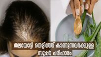 തലയോട്ടി കാണും പോലെ മുടി പോവുന്നോ: മുടി  ഇട തിങ്ങി വളരാന്‍ ആഴ്ചയില്‍ രണ്ട് തവണ