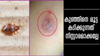 കുട്ടികളെ മൂട്ടകടി അലട്ടുന്നോ? ശരീരത്തിലെ ചുവന്ന് തടിച്ച പാടുകള്‍ നിസ്സാരമല്ല