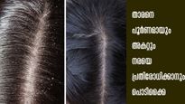 തൈരും കറിവേപ്പിലയും: ഒറ്റമുടിയിഴ നരക്കില്ല താരന്‍ കടുത്തതെങ്കിലും ഇളക്കി മാറ്റും