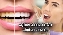 പല്ലിലെ നിറവ്യത്യാസം കെടുത്തും നിങ്ങളുടെ ആത്മവിശ്വാസം; മഞ്ഞക്കറയ്ക്ക് പിന്നിലെ കാരണം