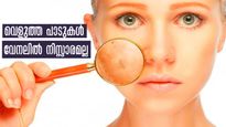 ചര്‍മ്മത്തിലെ വെളുത്ത പാടുകള്‍ കൂടുന്നോ? വെള്ളപ്പാണ്ട് അല്ല, പക്ഷേ ശ്രദ്ധിക്കണം