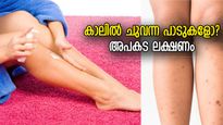 കാലുകളിൽ ചുവന്ന പാടുകളും കുരുക്കളും, ലക്ഷണങ്ങള്‍ അവഗണിക്കല്ലേ..