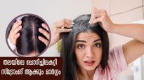 മഴക്കാലം തലയിലെ ചൊറിച്ചില്‍ മാറുന്നില്ലേ, വീട്ടില്‍ തന്നെ പരിഹാരം കാണാം