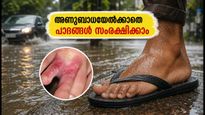 മഴവെള്ളത്തിൽ ഇറങ്ങുമ്പോൾ സൂക്ഷിക്കണം! അണുബാധയേൽക്കാതെ പാദങ്ങൾ സംരക്ഷിക്കാൻ ഈ മുൻകരുതലുകൾ മതി