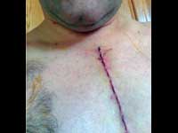 Surgery-Scar Surgery-Scar