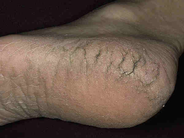  സ്ത്രീകളില്‍ തടി വരുത്തും പ്രശ്‌നങ്ങള്‍